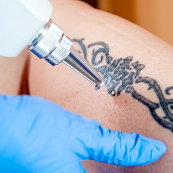 Dövme Silme & Leke Tedavileri